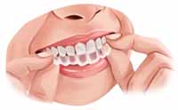 alineación dental invisible removible